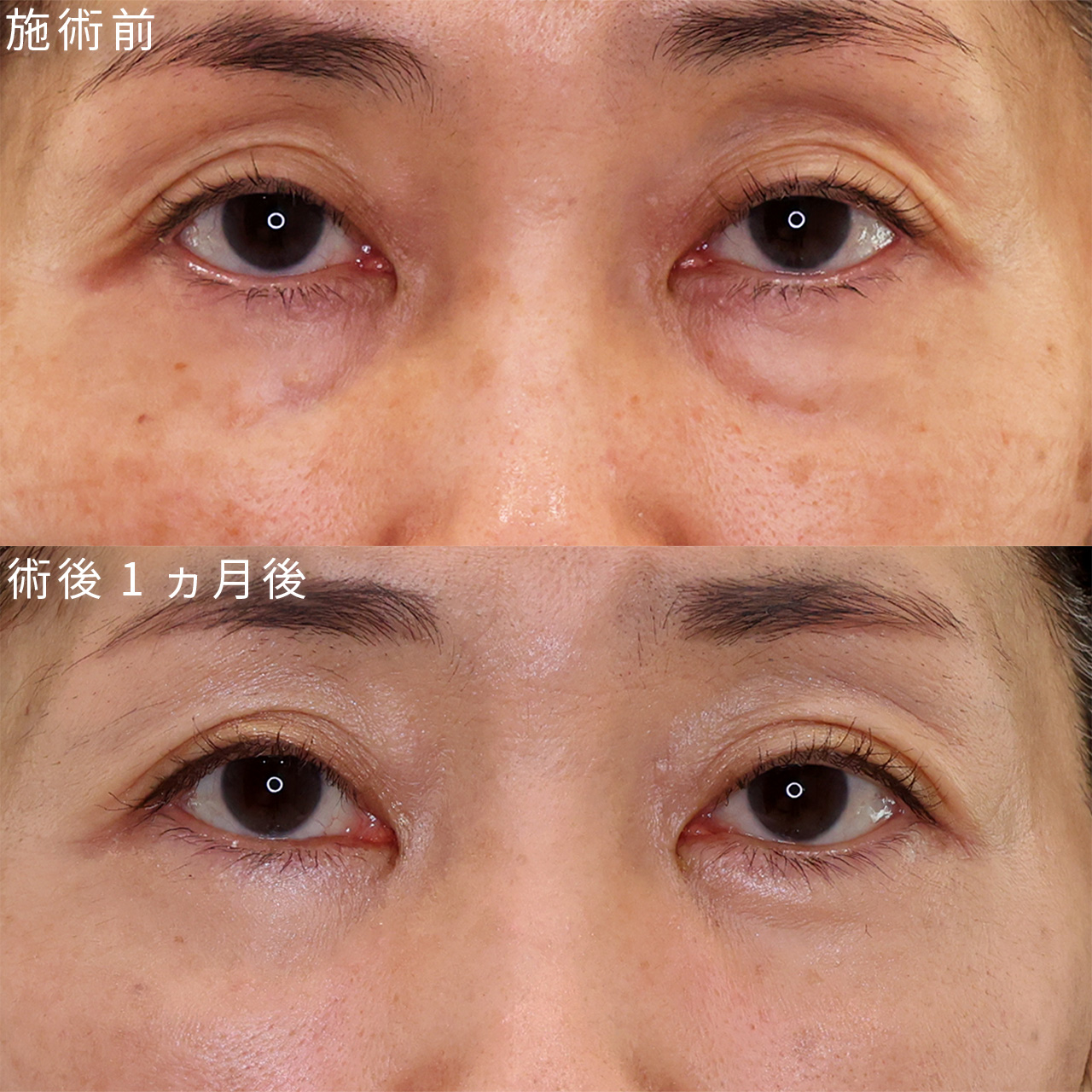 【裏ハムラ】のみでスッキリ健康的なお目元へ