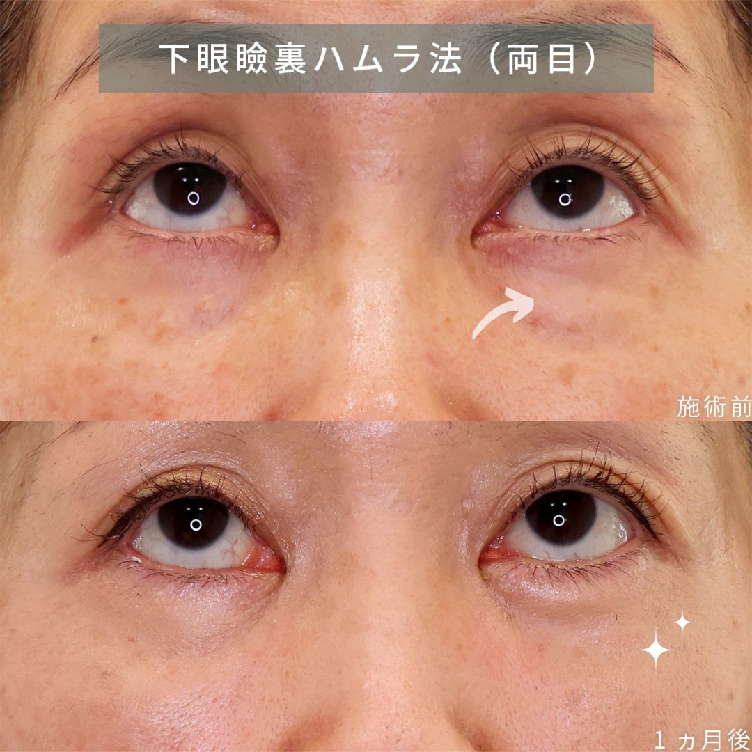 目元：その他の症例写真 施術前後 