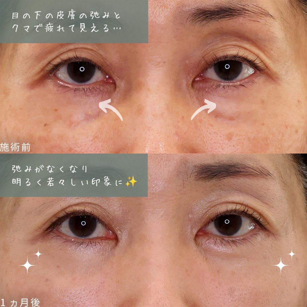 目元：その他の症例写真 施術前後 