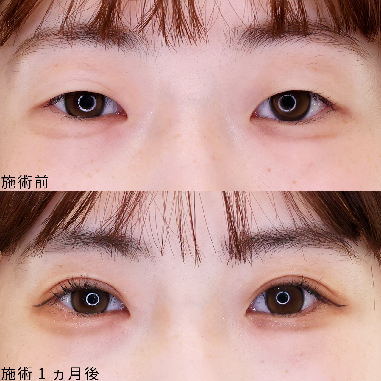 【二重埋没法】人生を豊かにする二重埋没