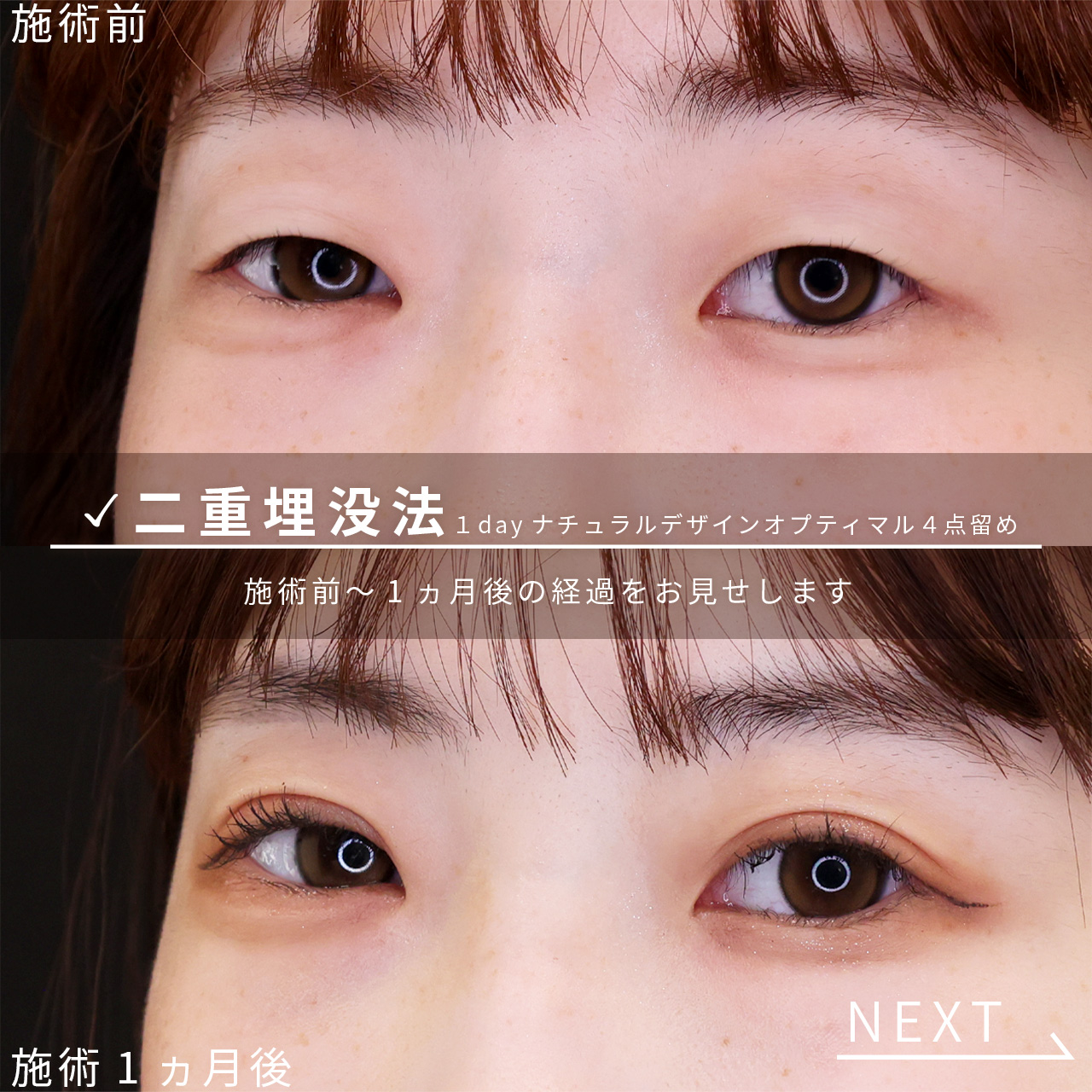 二重埋没法の症例写真 施術前後 