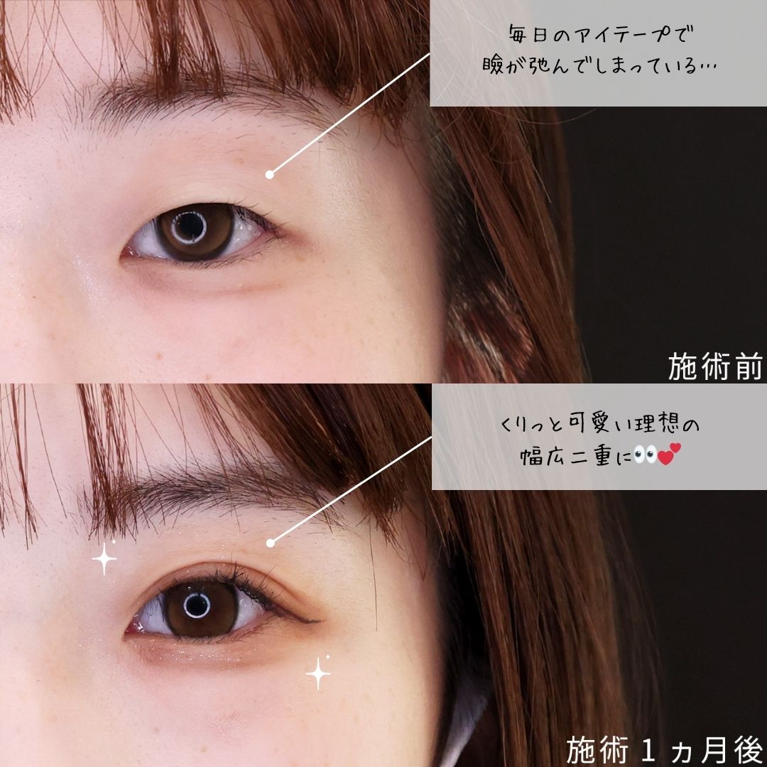 二重埋没法の症例写真 施術前後 