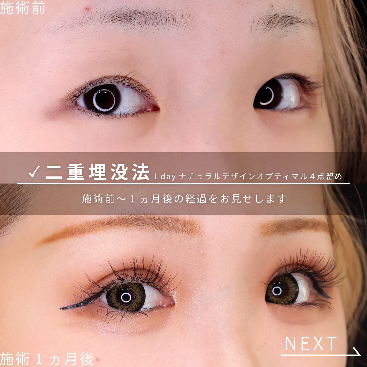 二重埋没法の症例写真 施術前後 