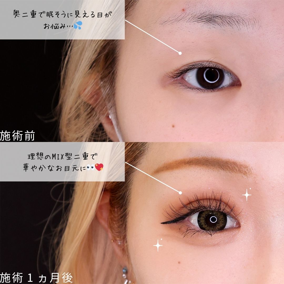 二重埋没法の症例写真 施術前後 