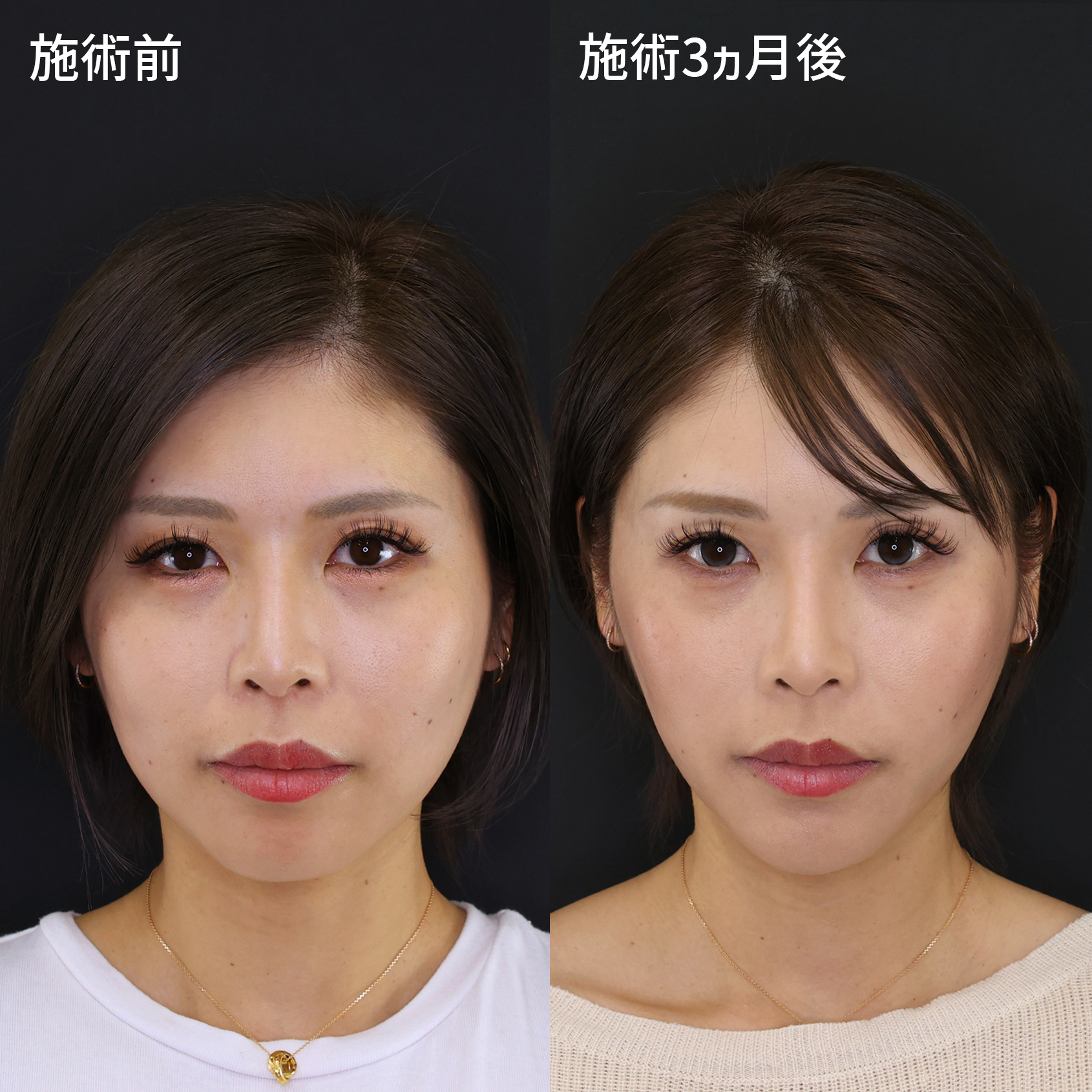 【糸リフト極＆脂肪除去】モデル級の小顔術でワンランクアップ！