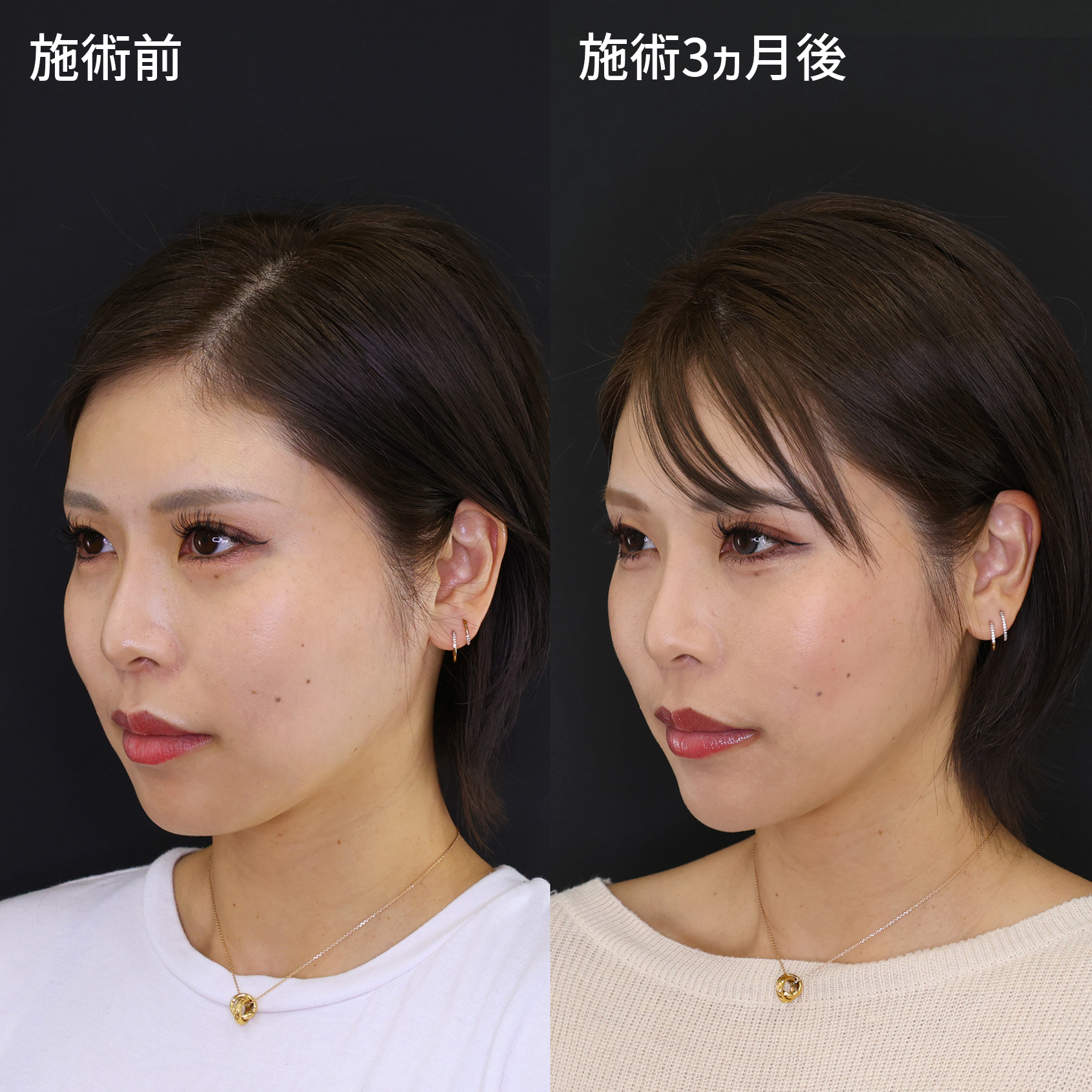 ジョールファット除去/TAC式 ツヤ肌コラーゲンリフト®/顎のヒアルロン酸注射の症例写真 施術前後 