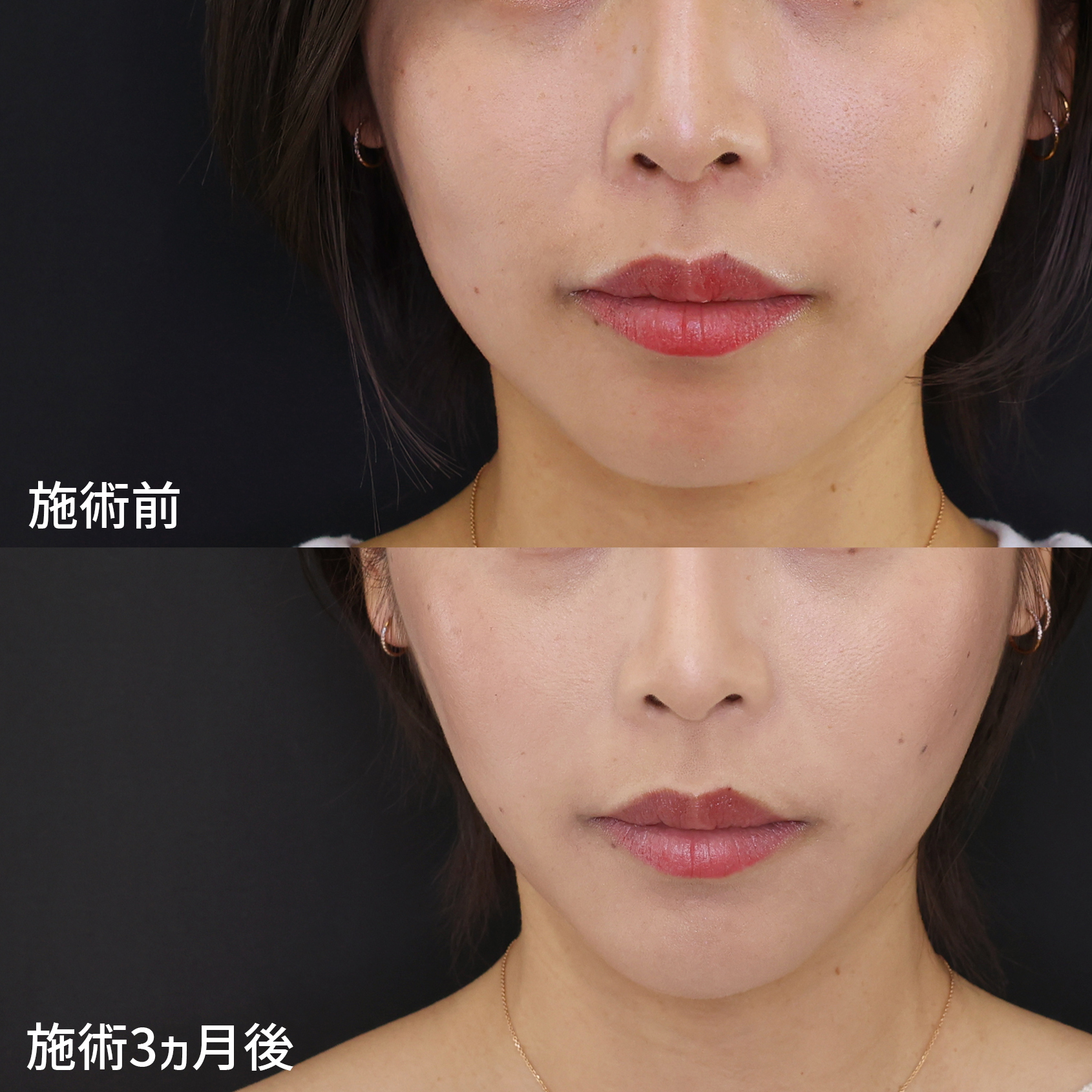 ジョールファット除去/TAC式 ツヤ肌コラーゲンリフト®/顎のヒアルロン酸注射の症例写真 施術前後 