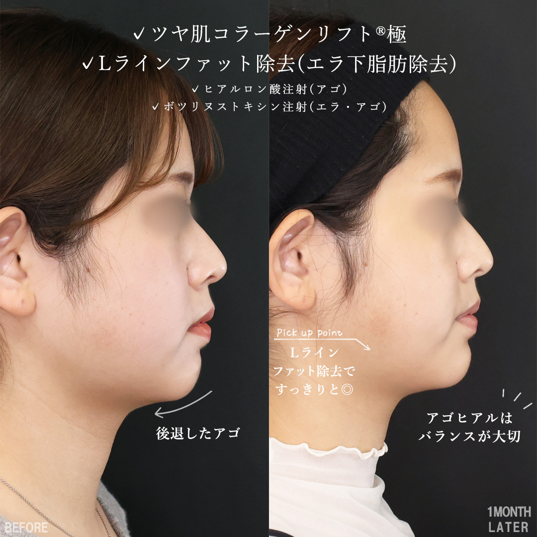 TAC式 ツヤ肌コラーゲンリフト®/Lラインファット除去(エラ下脂肪除去)/顎のヒアルロン酸注射の症例写真 施術前後