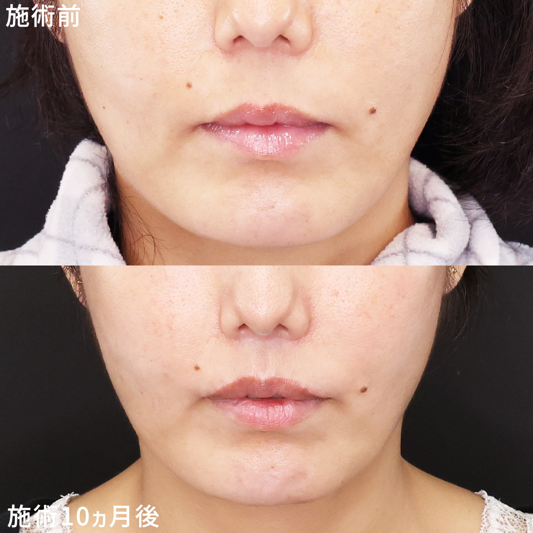 人中短縮×口角挙上で中顔面を短く≪長期経過シリーズ≫