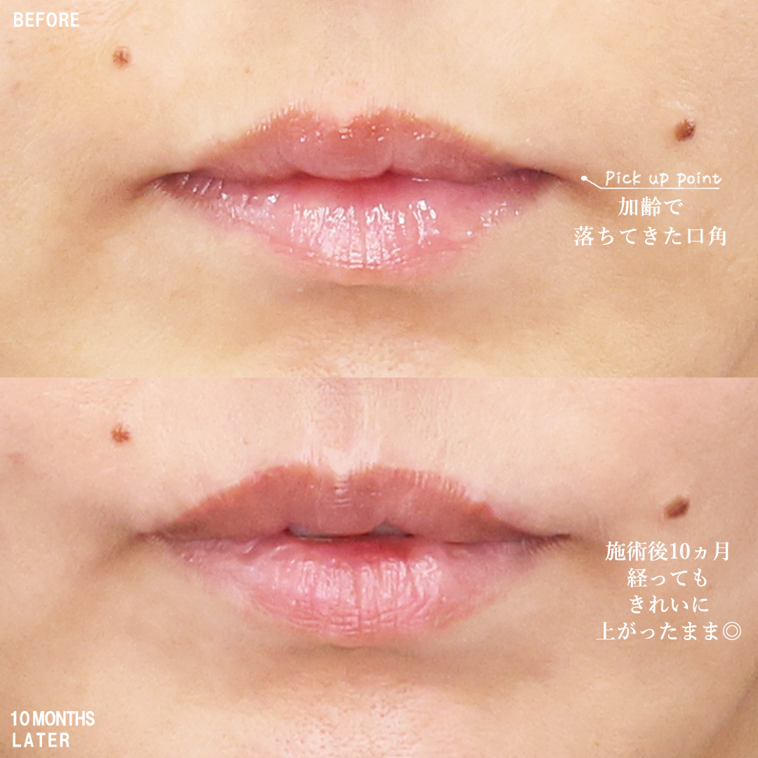人中短縮術(リップリフト)・外側人中短縮術/口角挙上・リフト（マイクロ切開法・内側法/口内法）/ボトックス注射：その他の症例写真 施術前後 