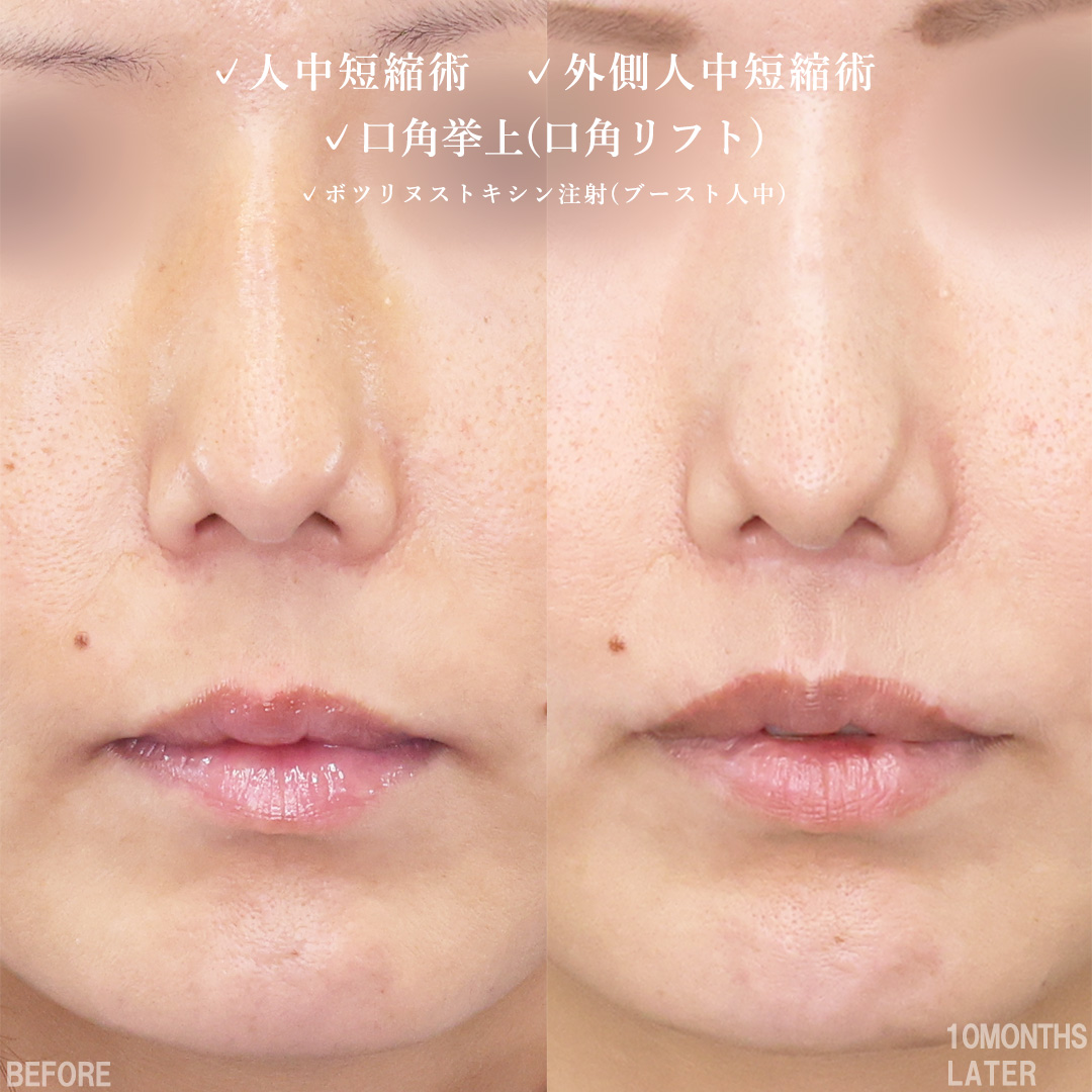 人中短縮術(リップリフト)・外側人中短縮術/口角挙上・リフト（マイクロ切開法・内側法/口内法）/ボトックス注射：その他の症例写真 施術前後 