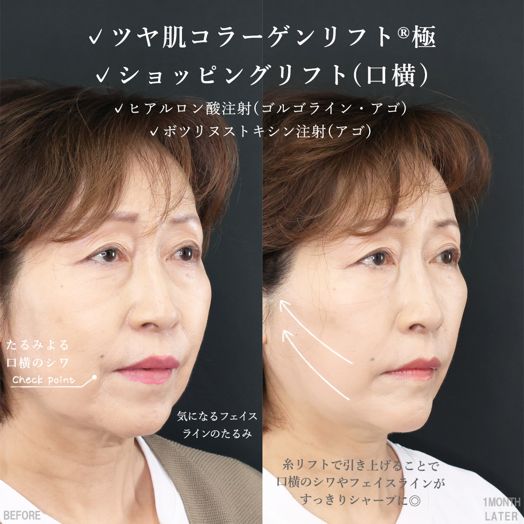 TAC式 ツヤ肌コラーゲンリフト®/TAC式 ショッピングリフト/ゴルゴ線のヒアルロン酸注射の症例写真 施術前後 