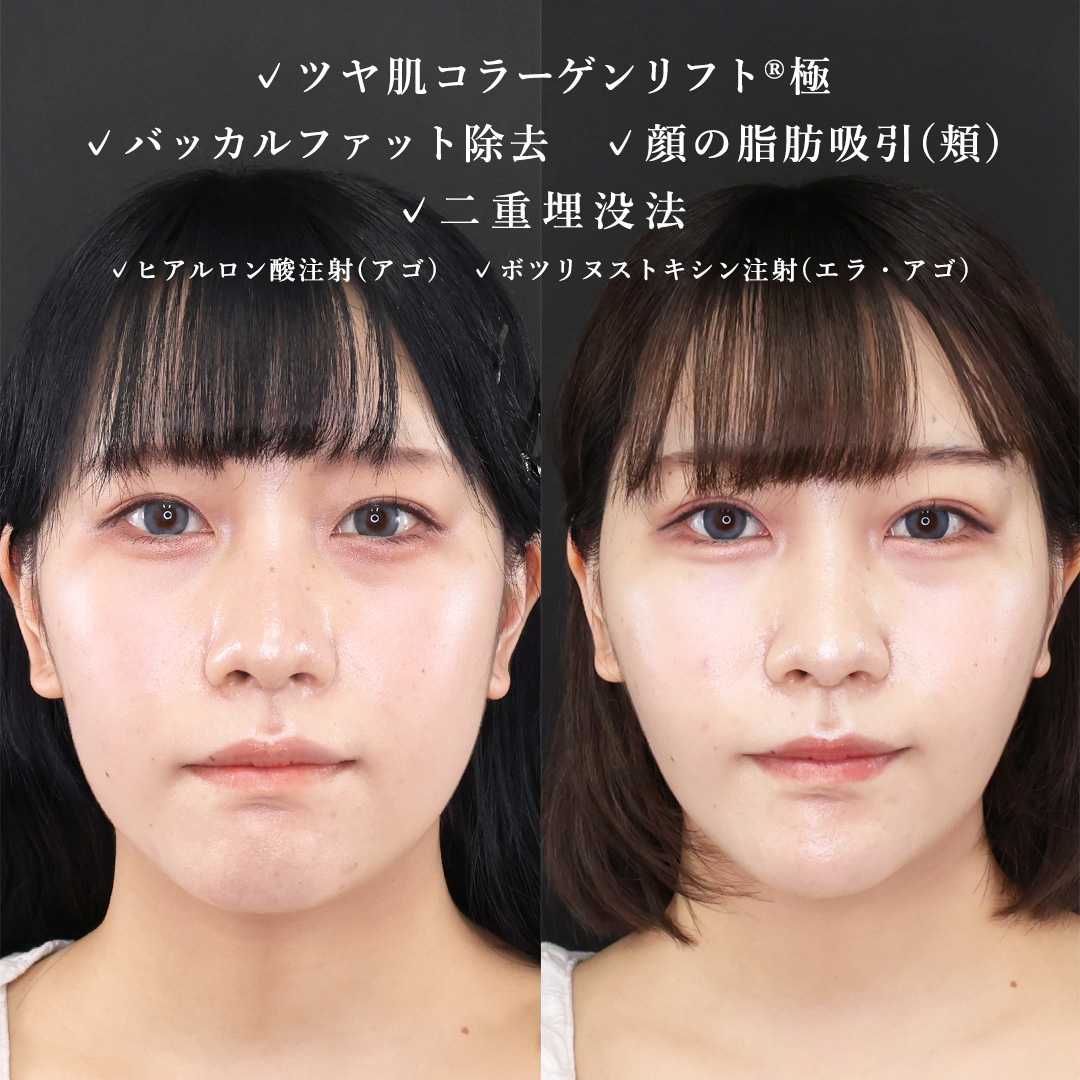 TAC式 ツヤ肌コラーゲンリフト®/バッカルファット除去/顔の脂肪吸引の症例写真 施術前後