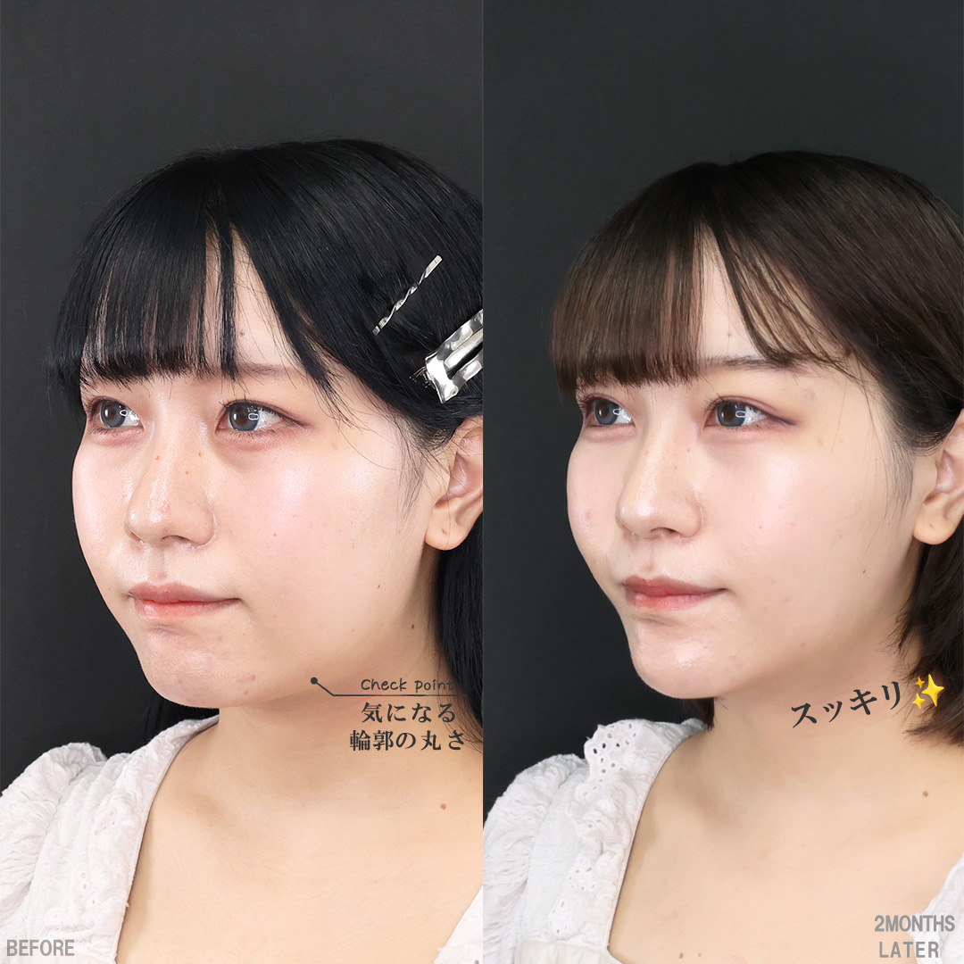 TAC式 ツヤ肌コラーゲンリフト®/バッカルファット除去/顔の脂肪吸引の症例写真 施術前後