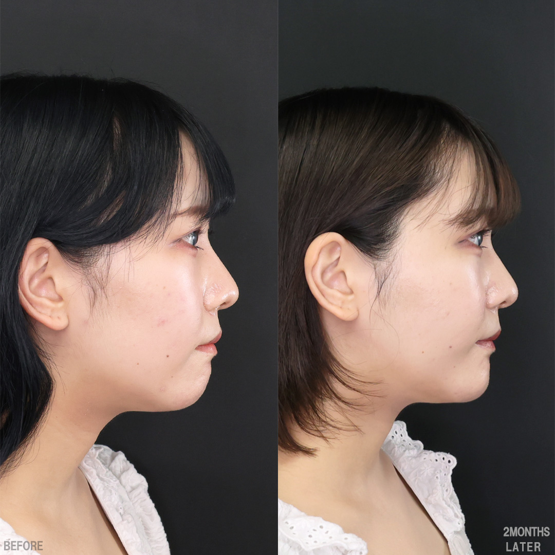 TAC式 ツヤ肌コラーゲンリフト®/バッカルファット除去/顔の脂肪吸引の症例写真 施術前後