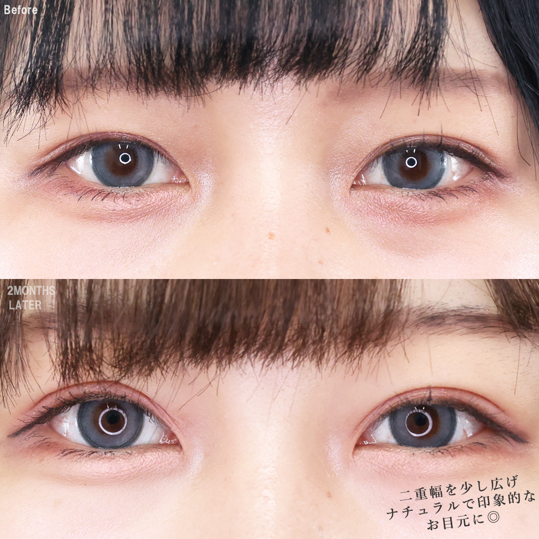 TAC式 ツヤ肌コラーゲンリフト®/バッカルファット除去/顔の脂肪吸引の症例写真 施術前後