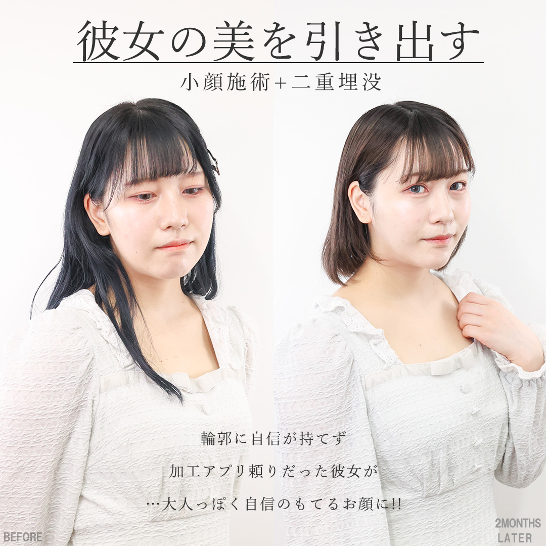 TAC式 ツヤ肌コラーゲンリフト®/バッカルファット除去/顔の脂肪吸引の症例写真 施術前後