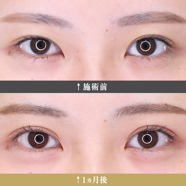 二重埋没法のダウンタイムはどれくらい？経過症例画像あり