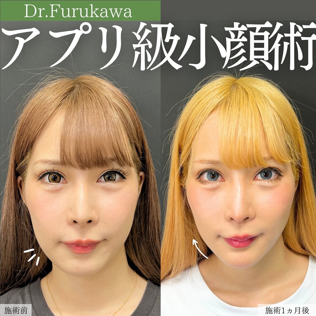 TAC式 ツヤ肌コラーゲンリフト®/顎のヒアルロン酸注射/エラボトックス注射の症例写真 施術前後 