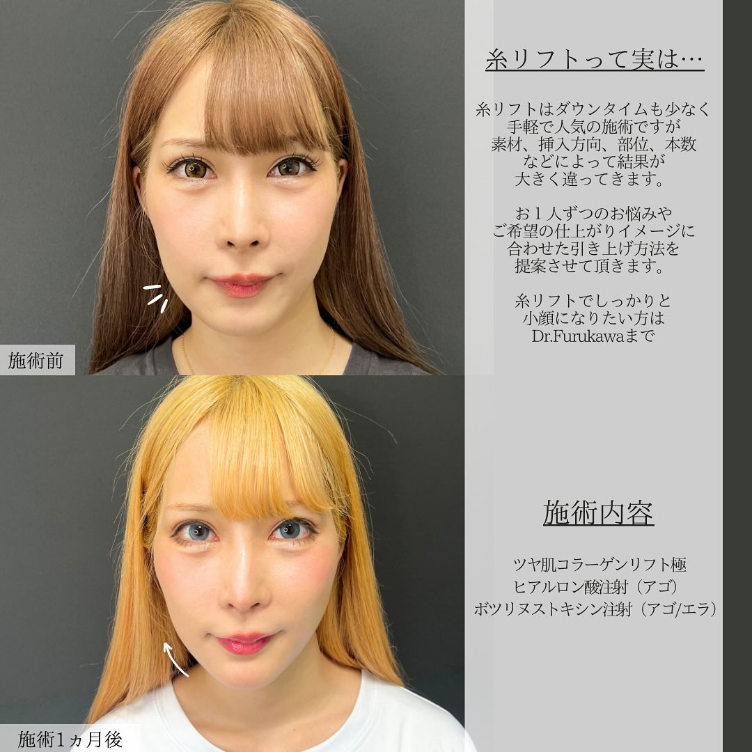 TAC式 ツヤ肌コラーゲンリフト®/顎のヒアルロン酸注射/エラボトックス注射の症例写真 施術前後 