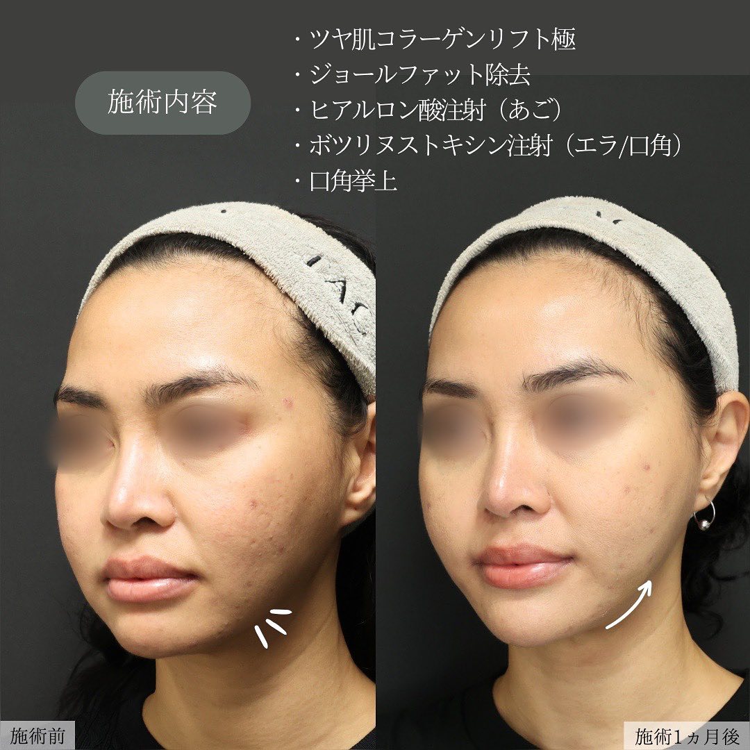 TAC式 ツヤ肌コラーゲンリフト®/ジョールファット除去/顎のヒアルロン酸注射の症例写真 施術前後 