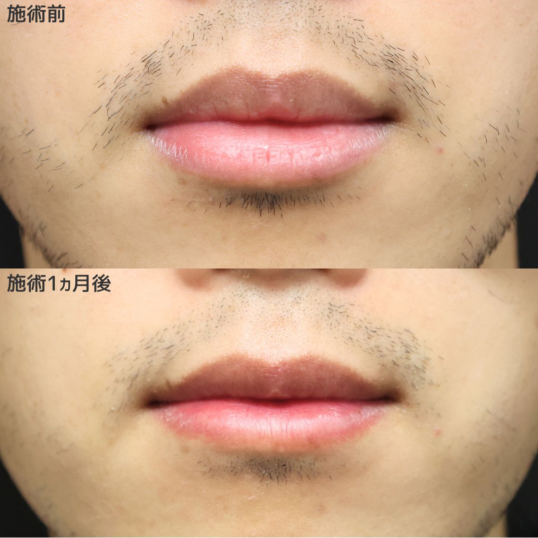 《口唇縮小術》厚ぼったい唇からすっきりした目立たない唇へ