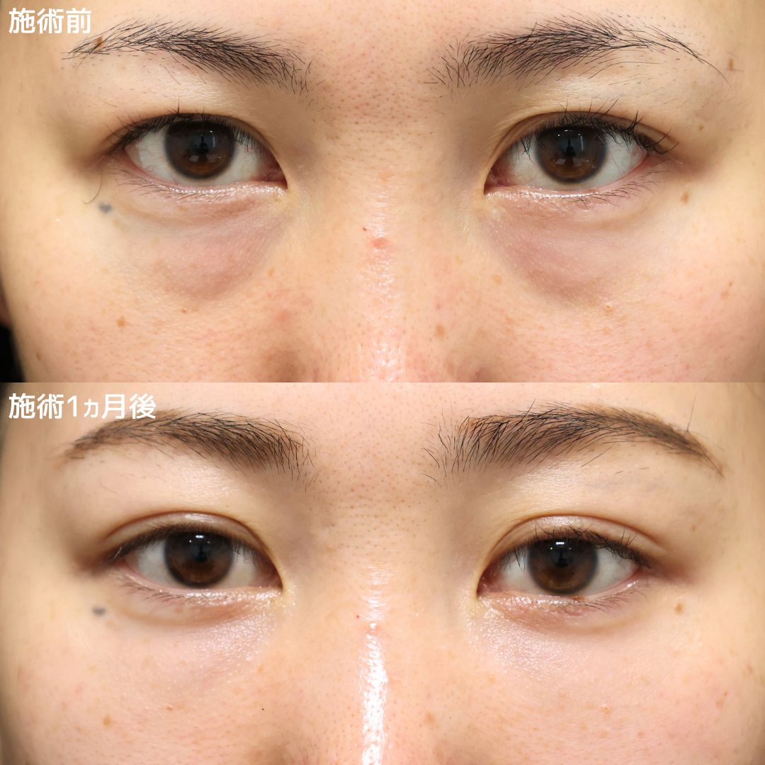 《クマ取り＋脂肪注入》メイクなしでも明るい表情へ