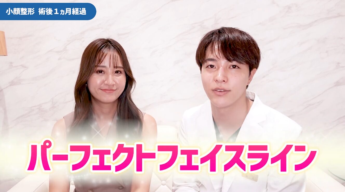 パーフェクトフェイスライン術後1カ月