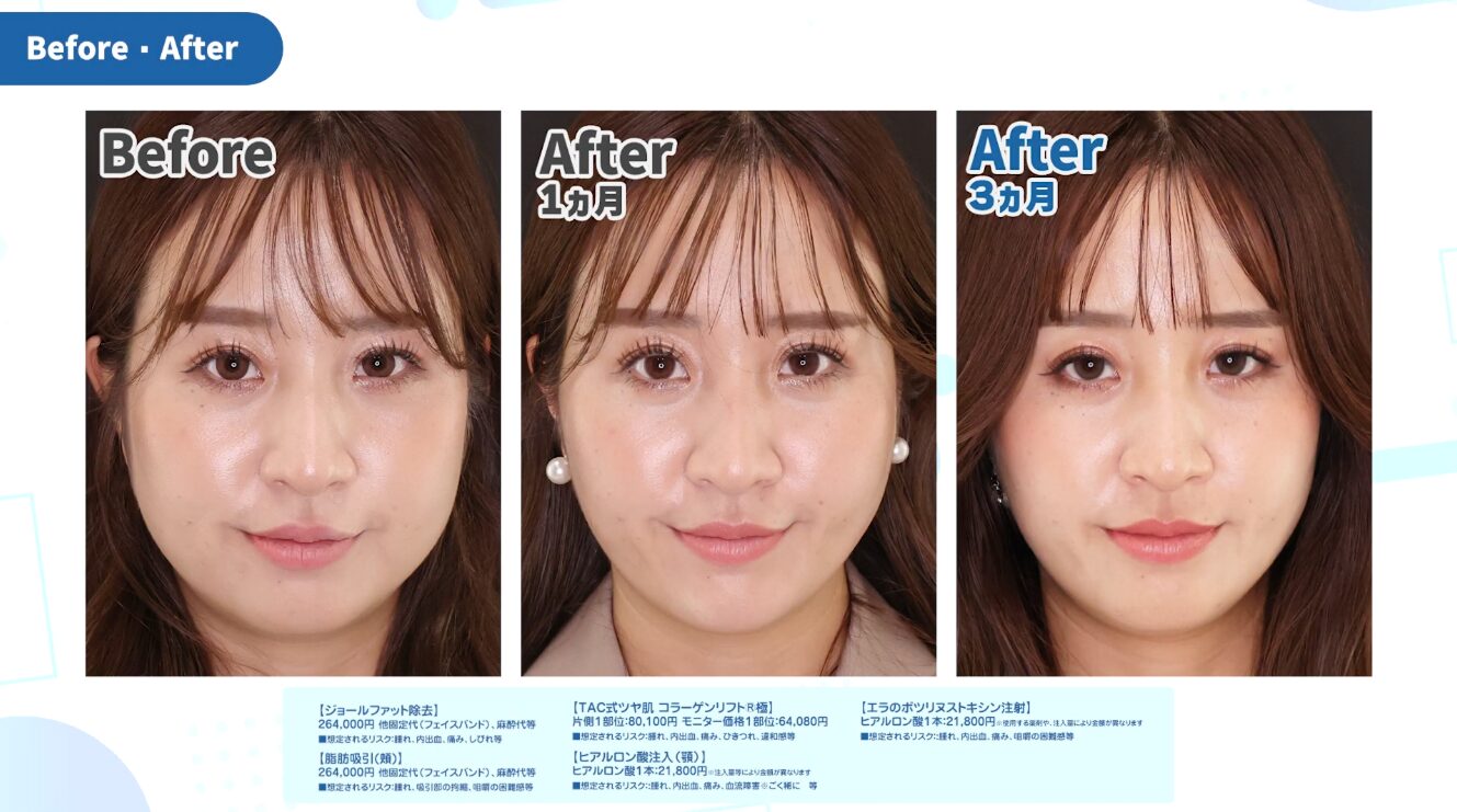 小顔整形の術前・術後1カ月・3カ月を比較した症例写真