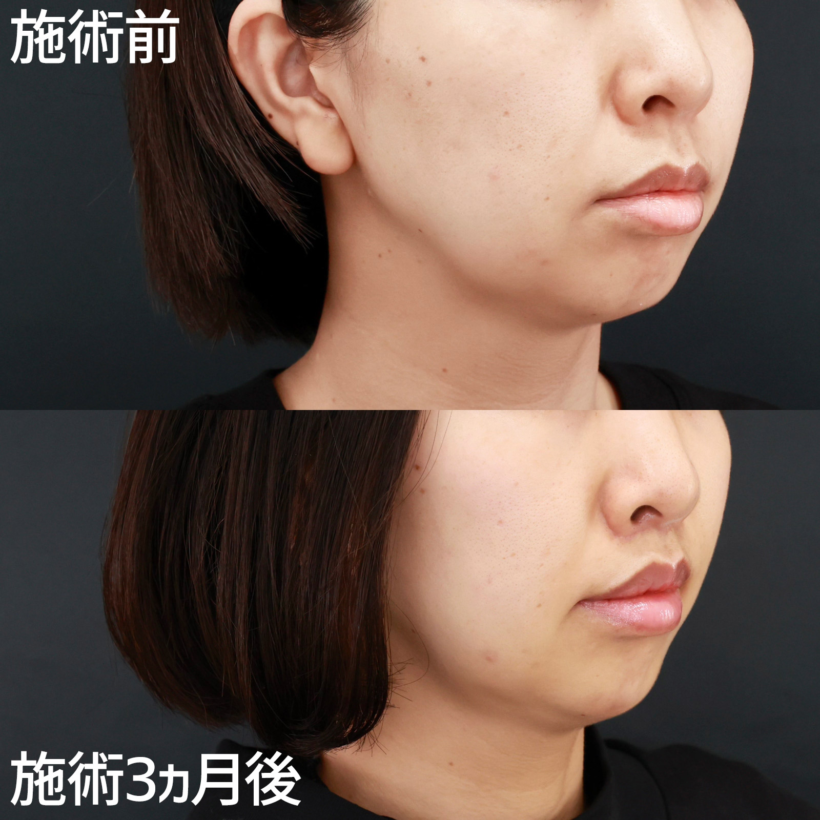 人中短縮術(リップリフト)・外側人中短縮術/顎のヒアルロン酸注射/ボトックス注射：その他の症例写真 施術前後 