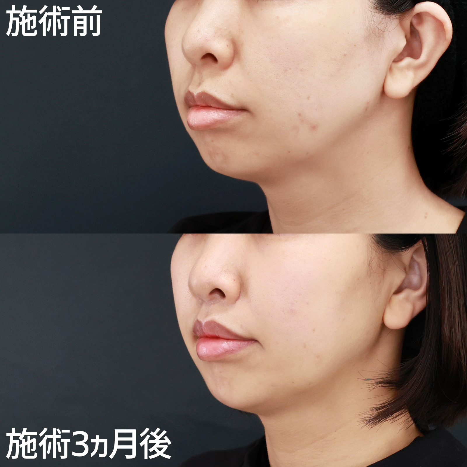 人中短縮術(リップリフト)・外側人中短縮術/顎のヒアルロン酸注射/ボトックス注射：その他の症例写真 施術前後 
