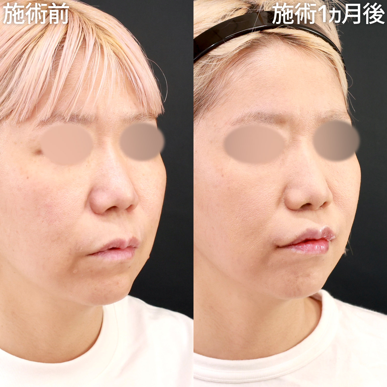 人中短縮術(リップリフト)・外側人中短縮術/口角挙上・リフト（マイクロ切開法・内側法/口内法）の症例写真 施術前後 