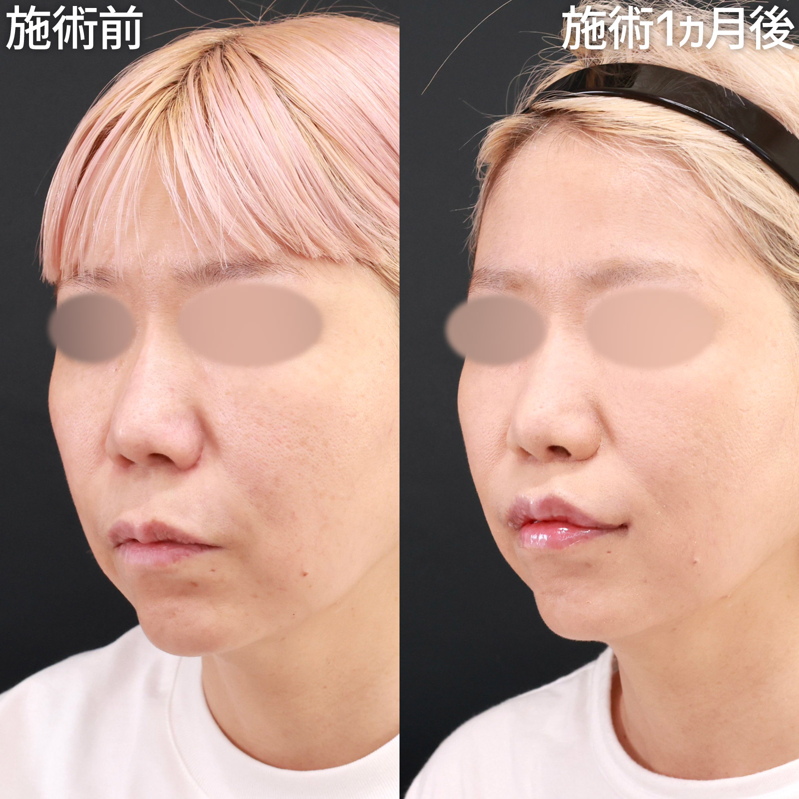 【口角挙上＆人中短縮】口元の印象が一気に若返る！