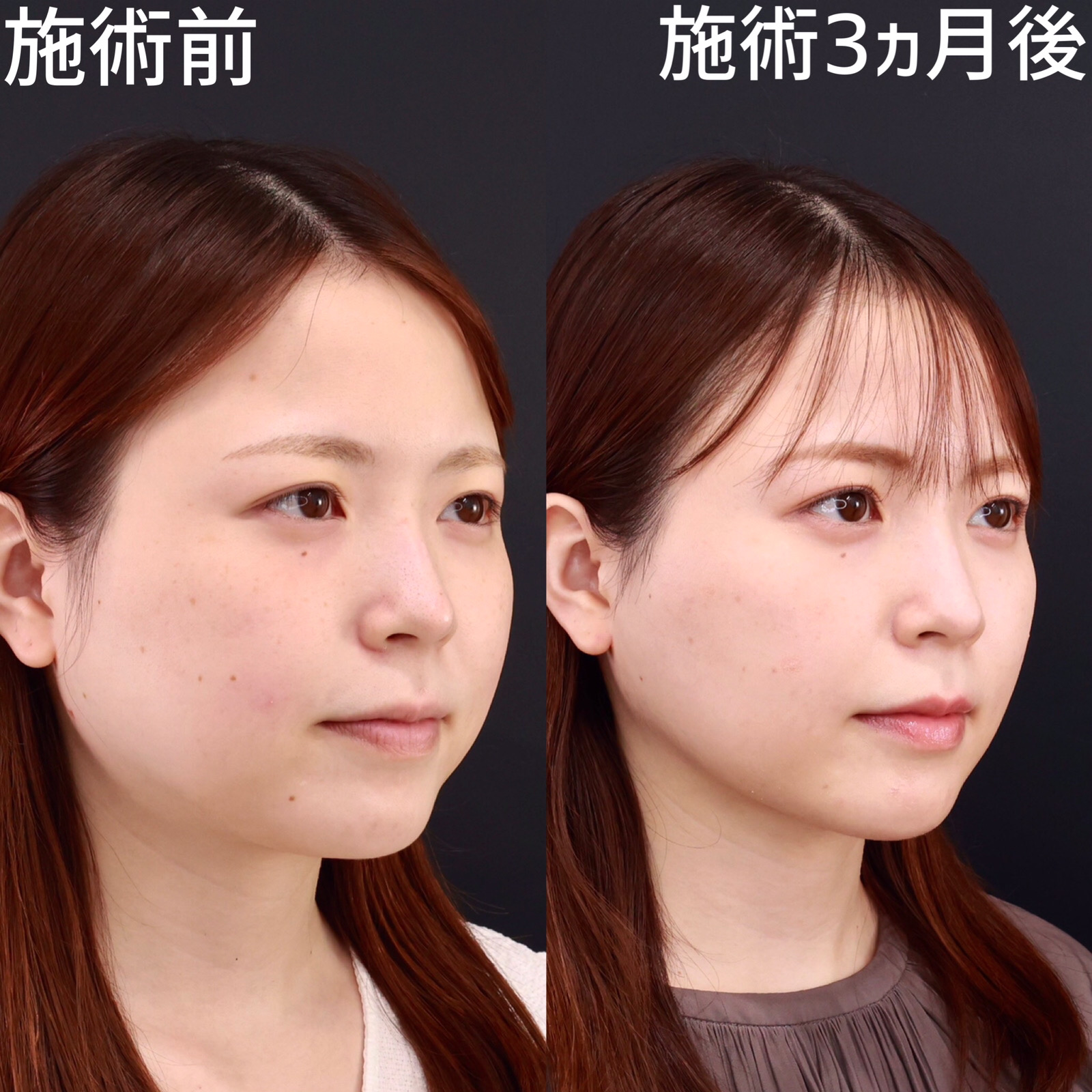 TAC式 ツヤ肌コラーゲンリフト®/顔の脂肪吸引/ジョールファット除去の症例写真 施術前後