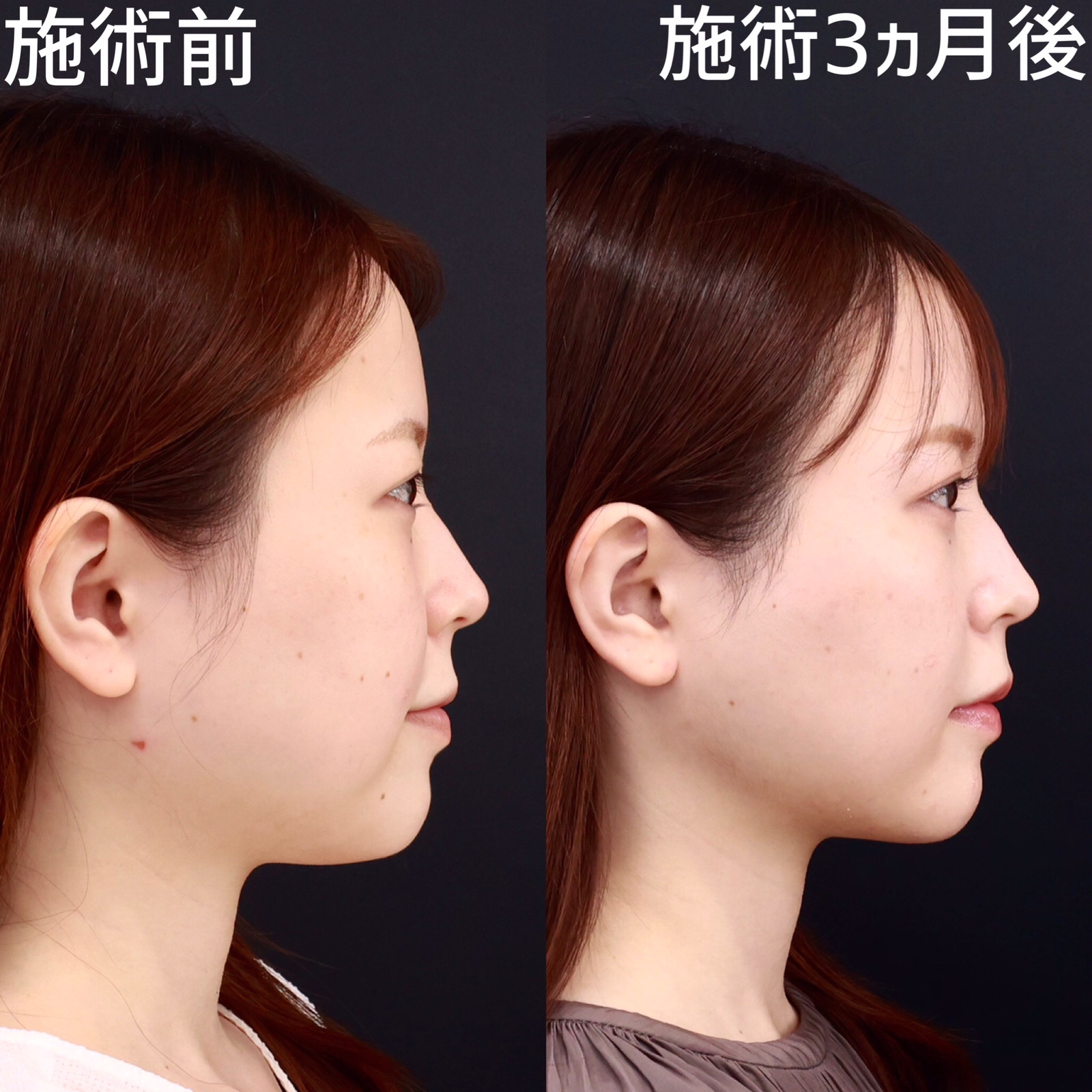 TAC式 ツヤ肌コラーゲンリフト®/顔の脂肪吸引/ジョールファット除去の症例写真 施術前後