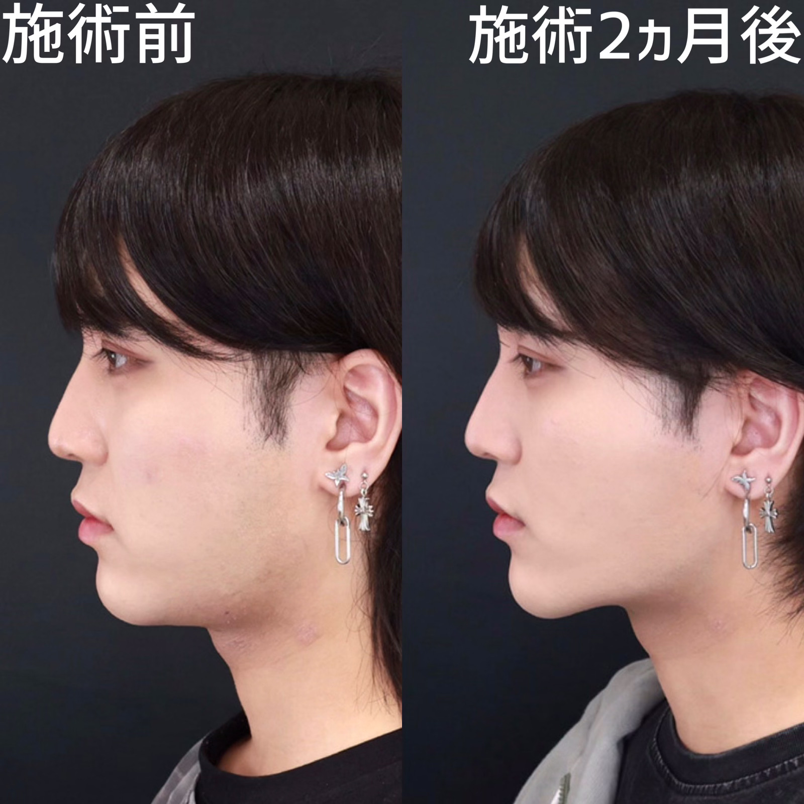 小顔整形|パーフェクトフェイスライン/TAC式 ツヤ肌コラーゲンリフト®/顔の脂肪吸引の症例写真 施術前後