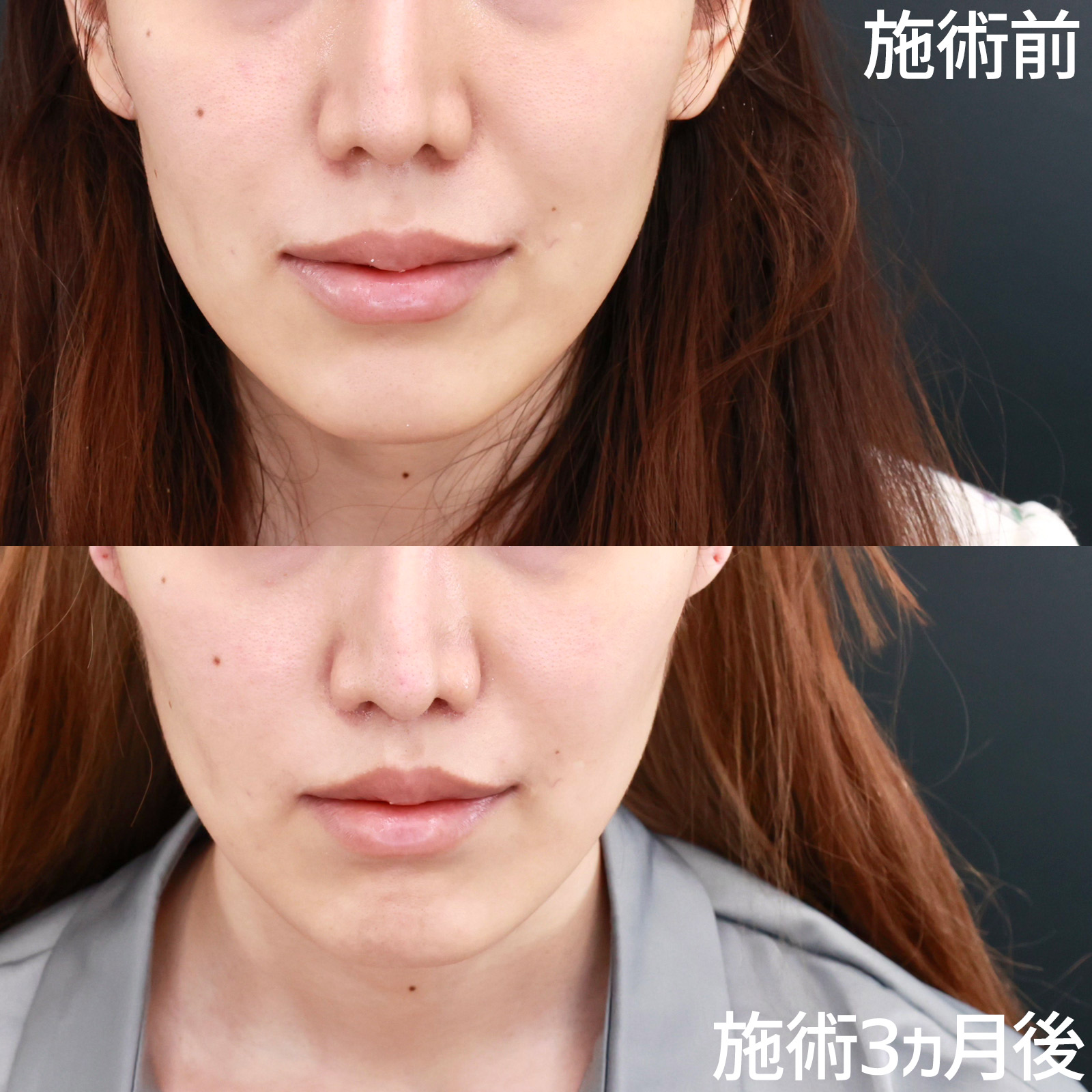 人中短縮術(リップリフト)・外側人中短縮術の症例写真 施術前後