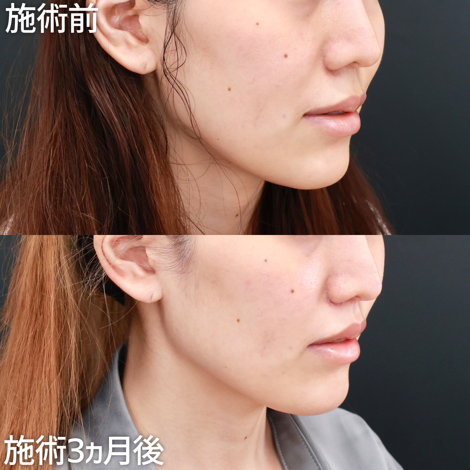 人中短縮術(リップリフト)・外側人中短縮術の症例写真 施術前後