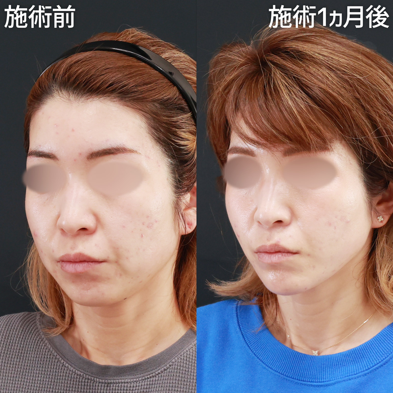 TAC式 ツヤ肌コラーゲンリフト®/エラボトックス注射/小顔整形|パーフェクトフェイスラインの症例写真 施術前後