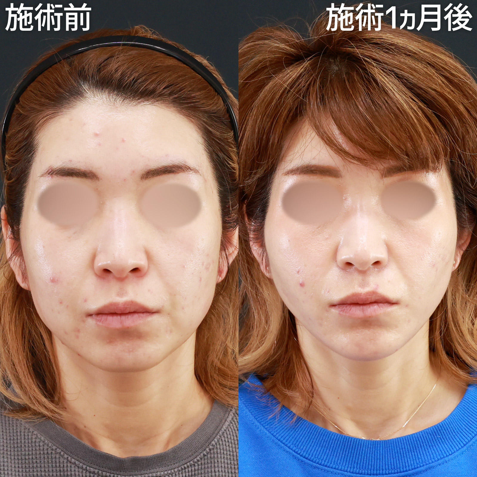 TAC式 ツヤ肌コラーゲンリフト®/エラボトックス注射/小顔整形|パーフェクトフェイスラインの症例写真 施術前後