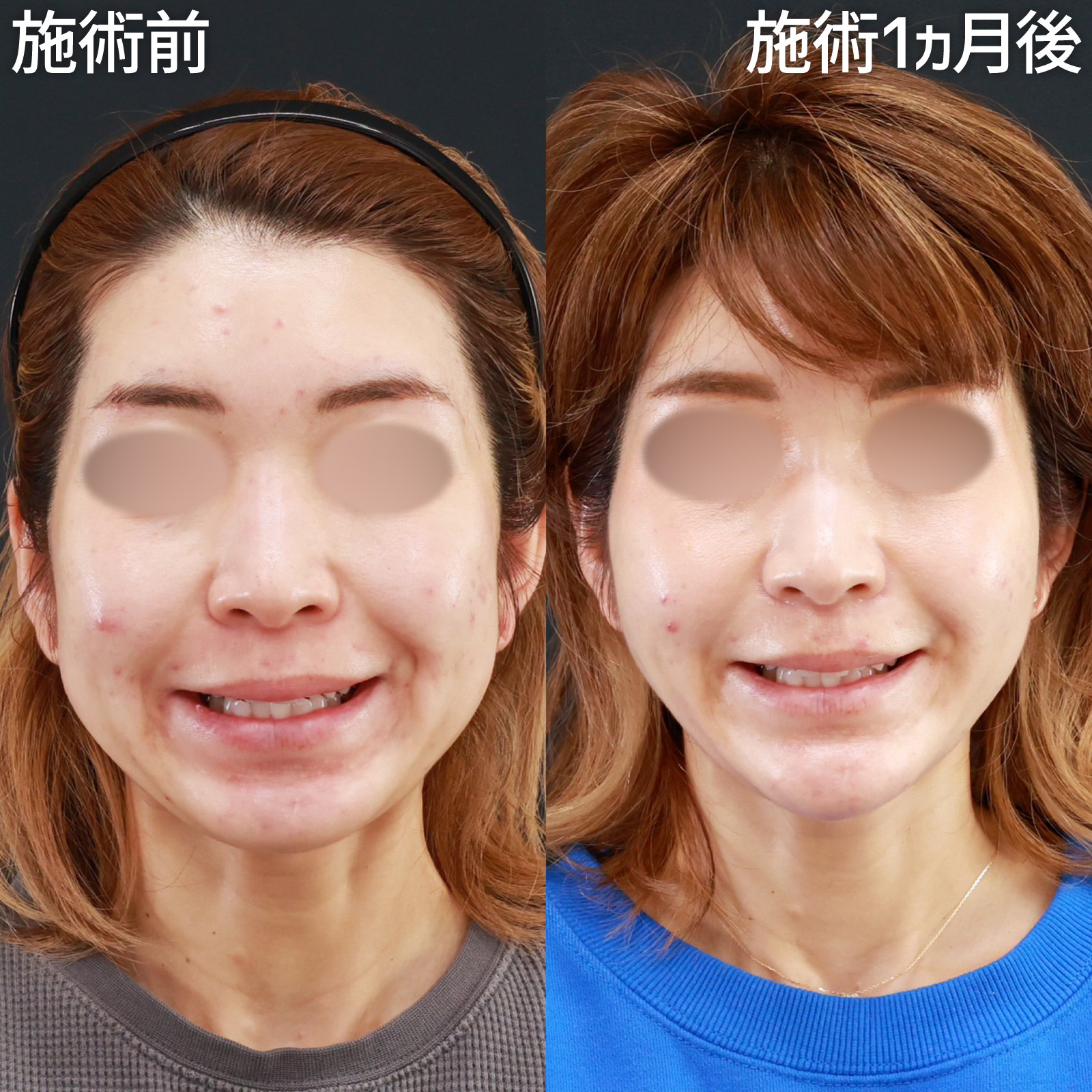 TAC式 ツヤ肌コラーゲンリフト®/エラボトックス注射/小顔整形|パーフェクトフェイスラインの症例写真 施術前後