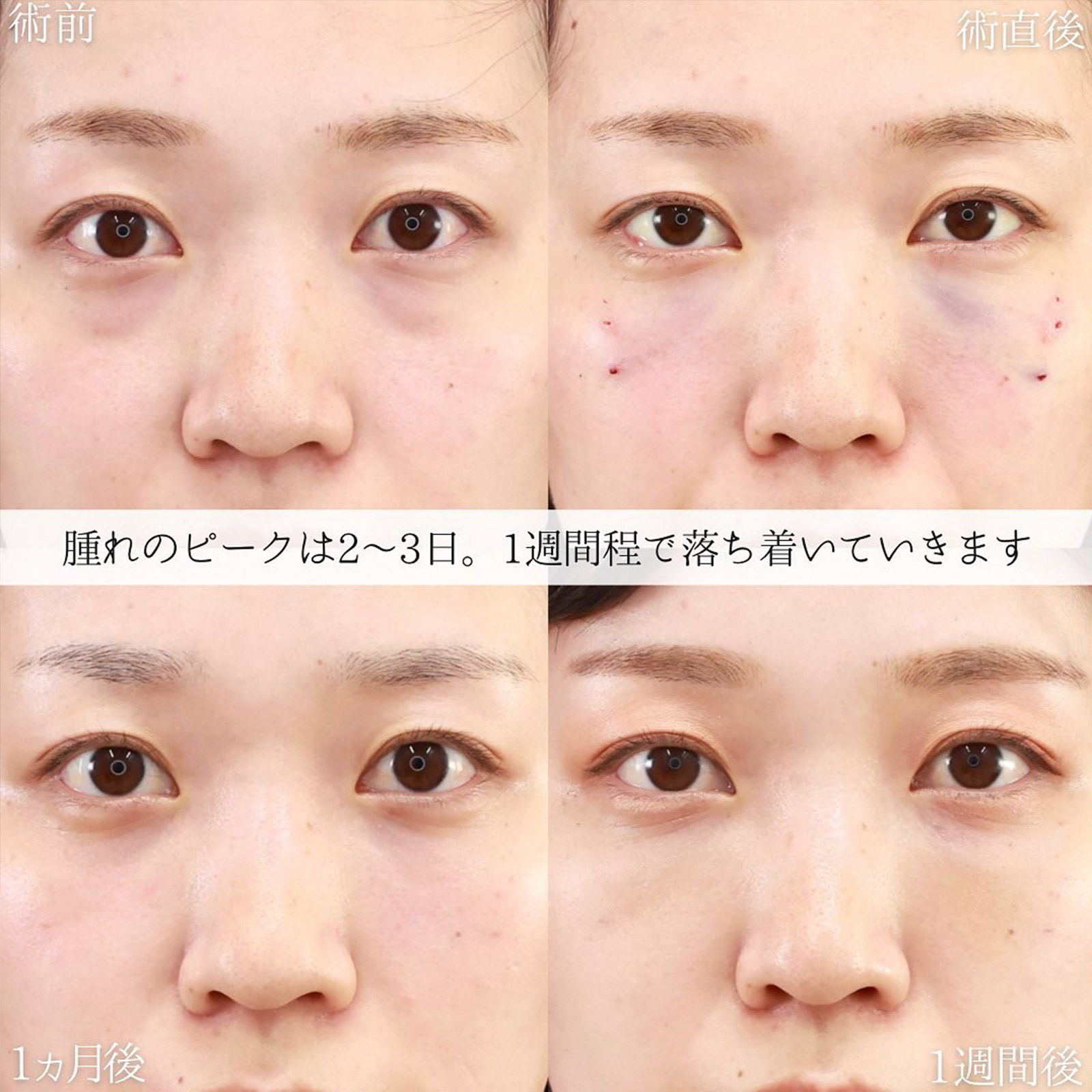 下眼瞼脱脂術（目の下のたるみ取り・目の下の脂肪ふくらみ取り）/顔の脂肪注入(コンデンスリッチフェイス)の症例写真 施術前後 