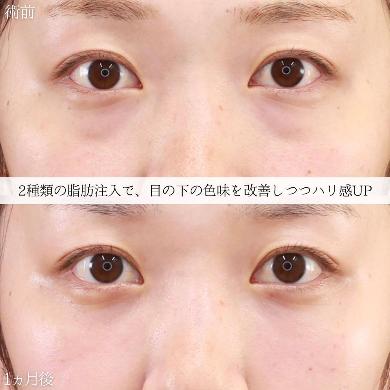 下眼瞼脱脂術（目の下のたるみ取り・目の下の脂肪ふくらみ取り）/顔の脂肪注入(コンデンスリッチフェイス)の症例写真 施術前後 