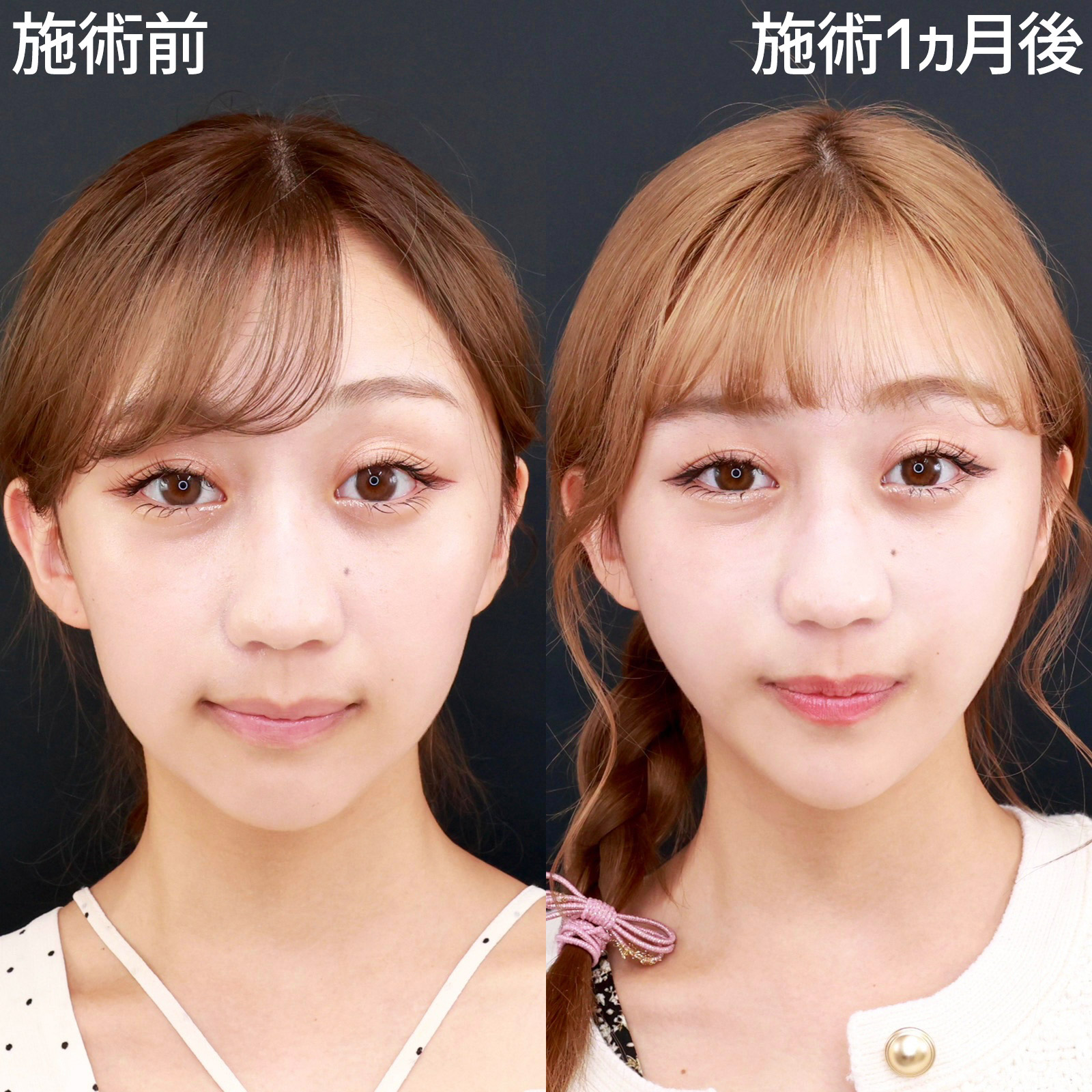 【糸リフト極＆脂肪除去】口横のポニョを消して、Vラインの輪郭に！