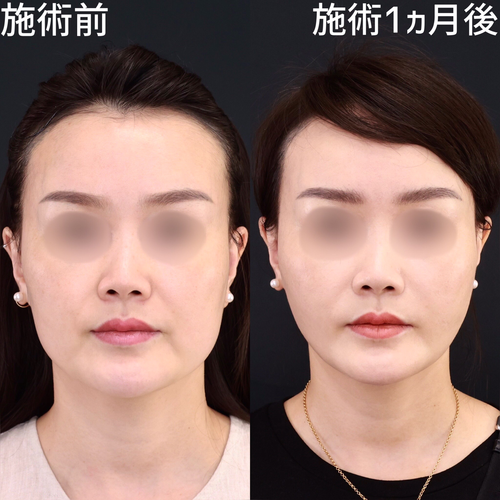 ルネセル　ヒアルロン酸andリニュー 頬のヒアルロン酸が垂れるか5年後まで画像比較 - アラフォー