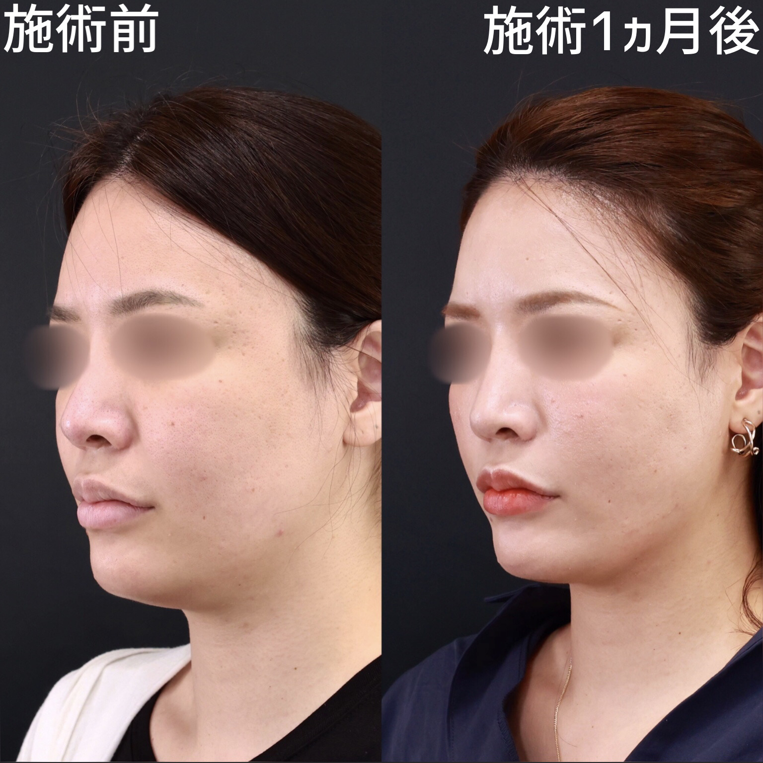 【糸リフト×顎下脂肪吸引】お顔のボリュームをしっかり落とす！