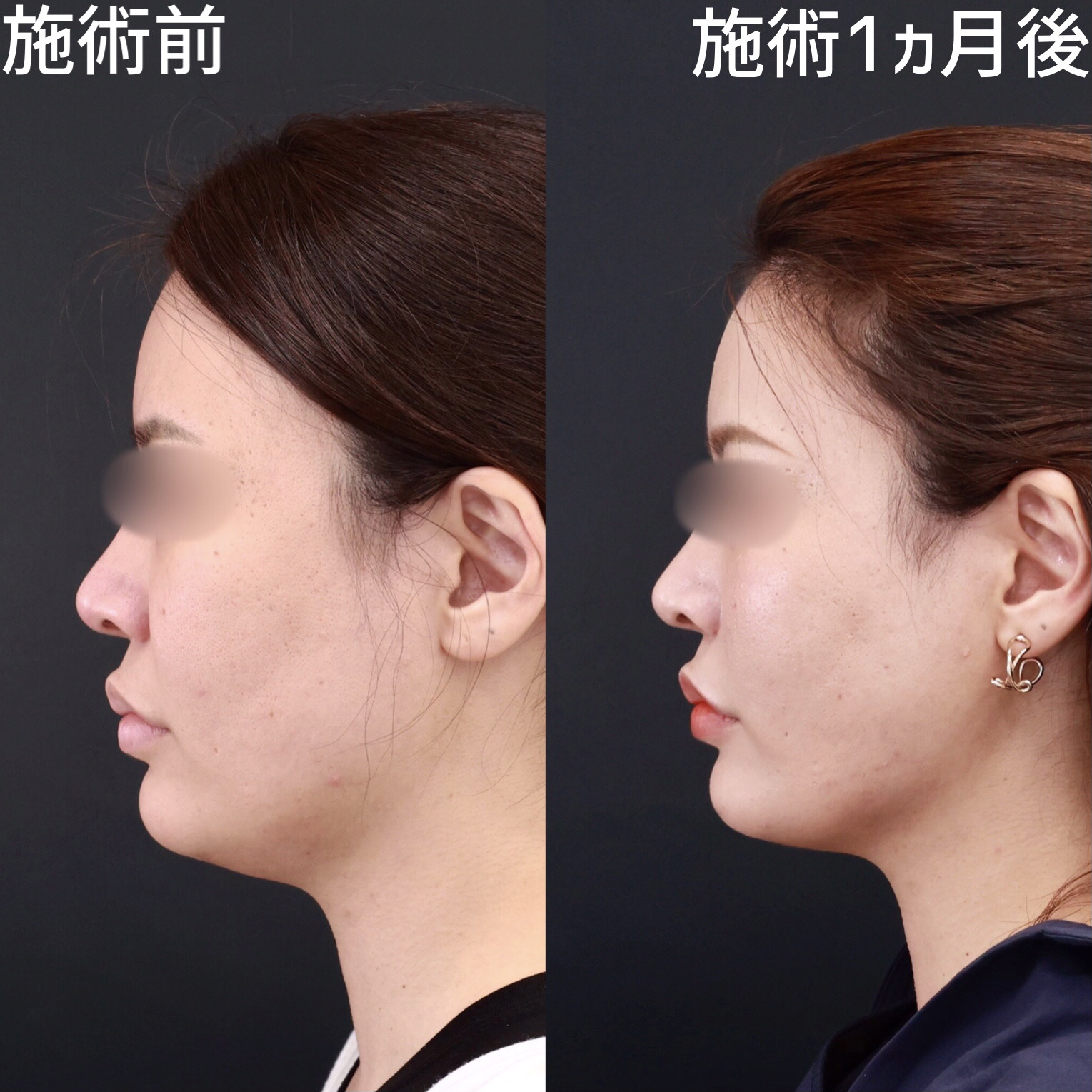 TAC式 ツヤ肌コラーゲンリフト®/顔の脂肪吸引/Lラインファット除去（エラ下脂肪除去）の症例写真 施術前後 