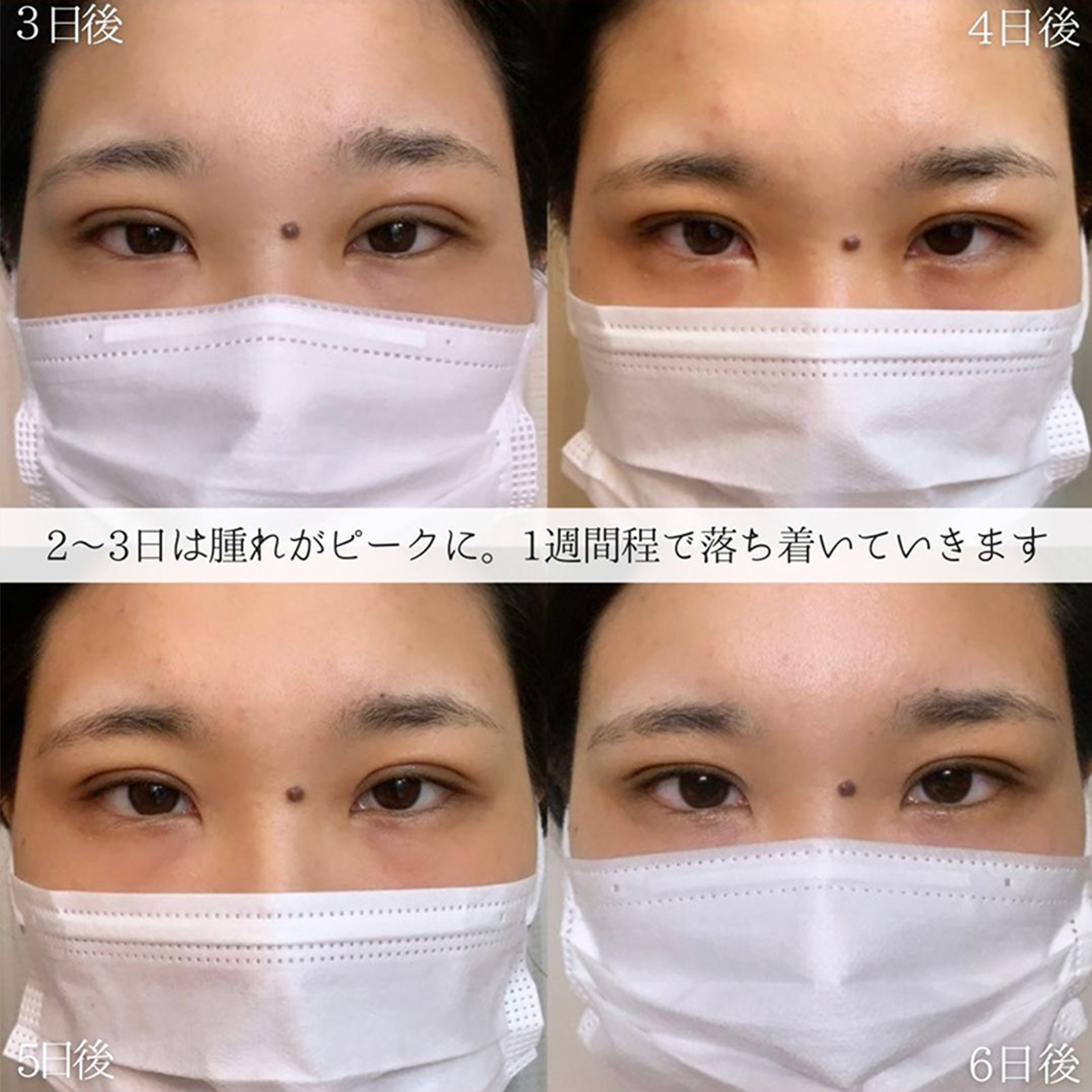 クイックコスメリングの症例写真 施術前後 