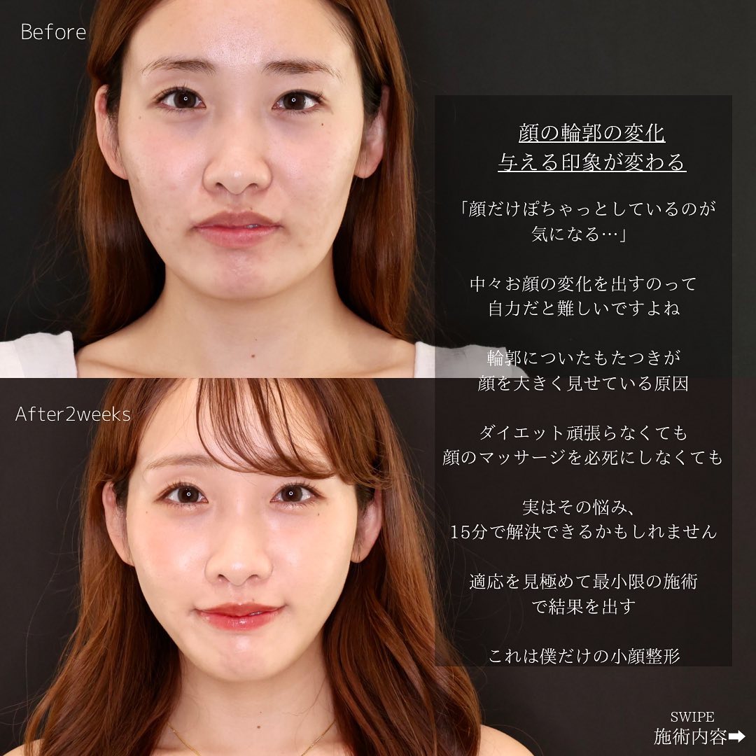 ジョールファット除去/TAC式 ツヤ肌コラーゲンリフト®の症例写真 施術前後 