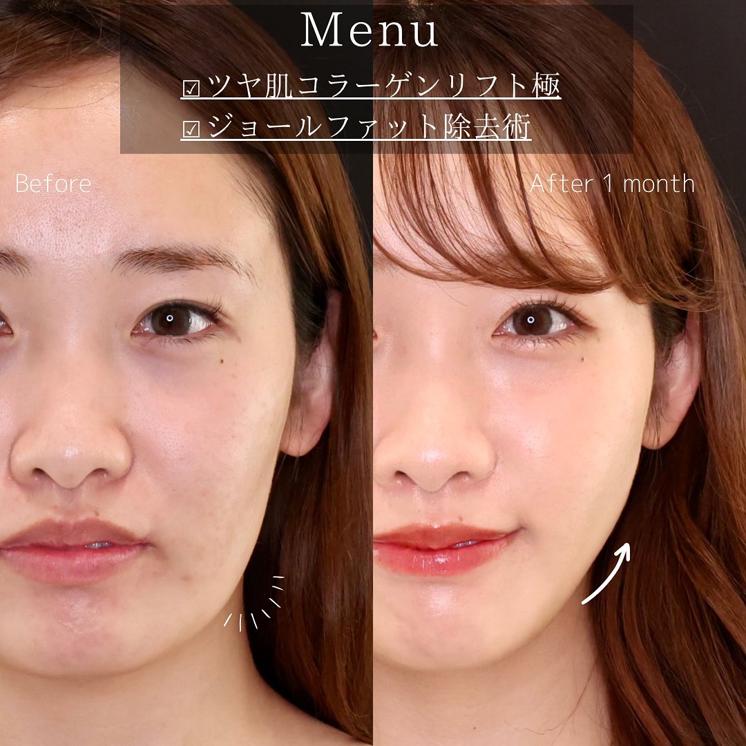 ジョールファット除去/TAC式 ツヤ肌コラーゲンリフト®の症例写真 施術前後 